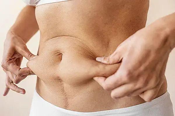 Who is a Good Candidate for Abdominoplasty?
